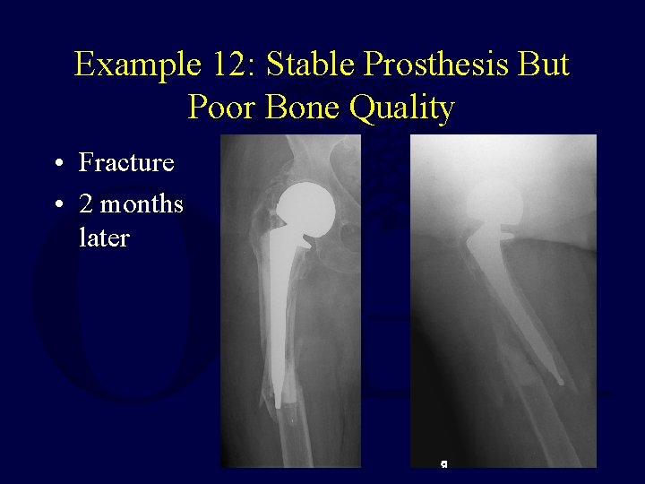 Example 12: Stable Prosthesis But Poor Bone Quality • Fracture • 2 months later