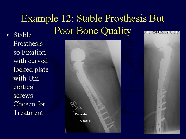  • Example 12: Stable Prosthesis But Poor Bone Quality Stable Prosthesis so Fixation