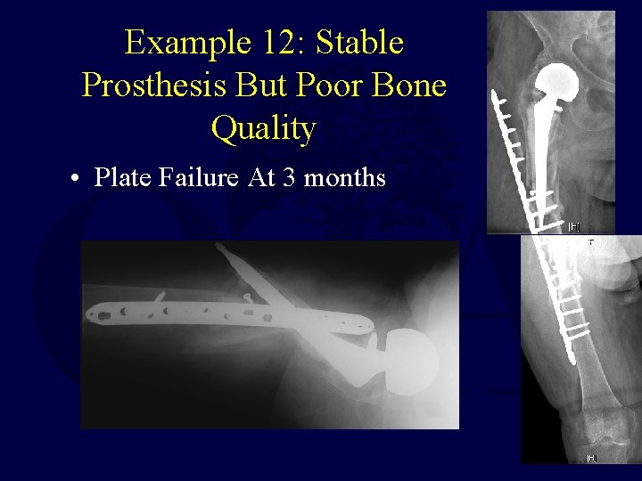 Example 12: Stable Prosthesis But Poor Bone Quality • Plate Failure At 3 months