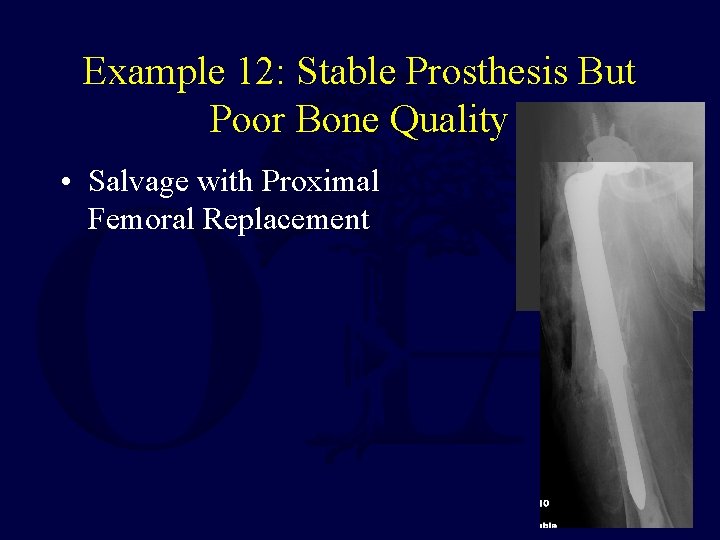 Example 12: Stable Prosthesis But Poor Bone Quality • Salvage with Proximal Femoral Replacement