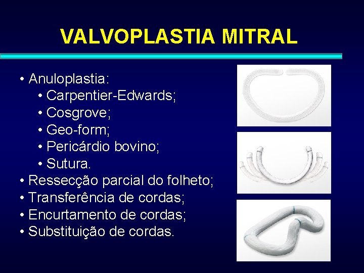 VALVOPLASTIA MITRAL • Anuloplastia: • Carpentier-Edwards; • Cosgrove; • Geo-form; • Pericárdio bovino; •