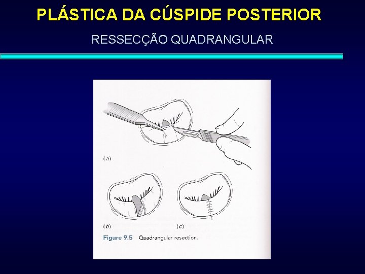 PLÁSTICA DA CÚSPIDE POSTERIOR RESSECÇÃO QUADRANGULAR 