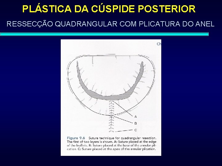 PLÁSTICA DA CÚSPIDE POSTERIOR RESSECÇÃO QUADRANGULAR COM PLICATURA DO ANEL 
