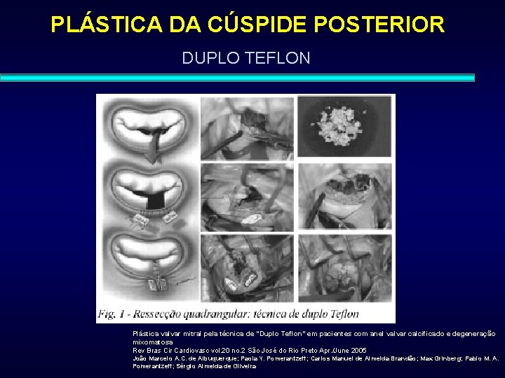 PLÁSTICA DA CÚSPIDE POSTERIOR DUPLO TEFLON Plástica valvar mitral pela técnica de "Duplo Teflon"