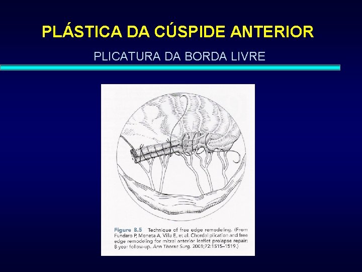 PLÁSTICA DA CÚSPIDE ANTERIOR PLICATURA DA BORDA LIVRE 