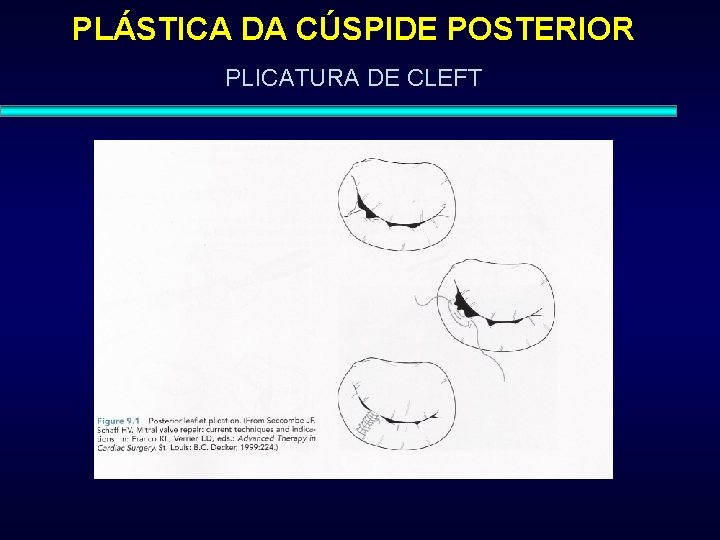 PLÁSTICA DA CÚSPIDE POSTERIOR PLICATURA DE CLEFT 
