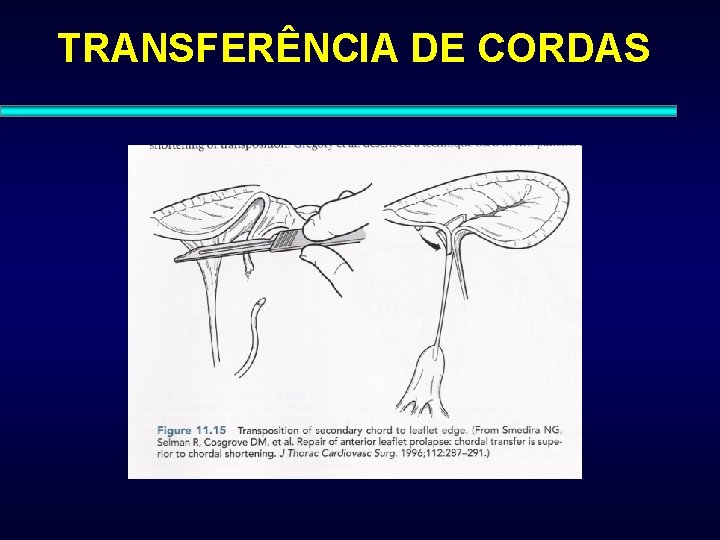 TRANSFERÊNCIA DE CORDAS 