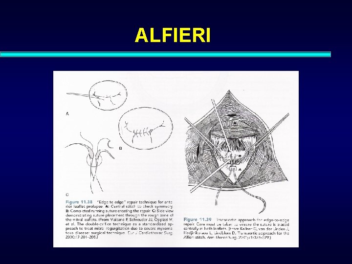 ALFIERI 