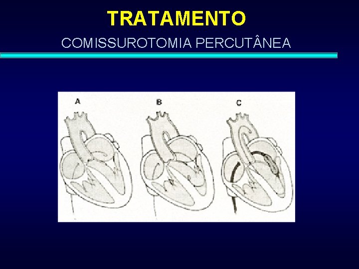 TRATAMENTO COMISSUROTOMIA PERCUT NEA 