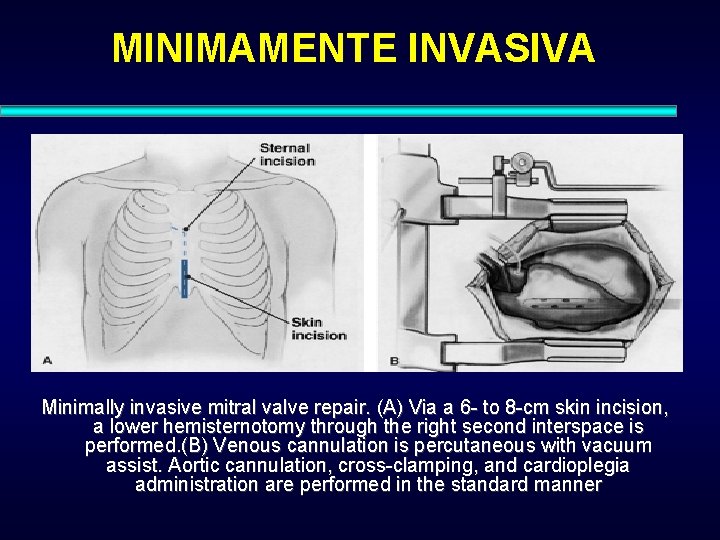 MINIMAMENTE INVASIVA Minimally invasive mitral valve repair. (A) Via a 6 - to 8