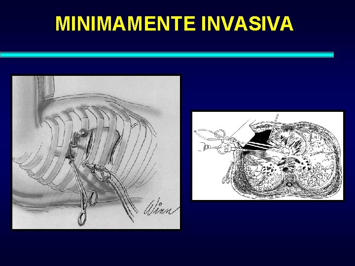 MINIMAMENTE INVASIVA 