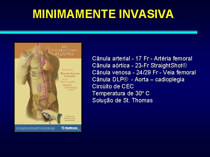 MINIMAMENTE INVASIVA Cânula arterial - 17 Fr - Artéria femoral Cânula aórtica - 23