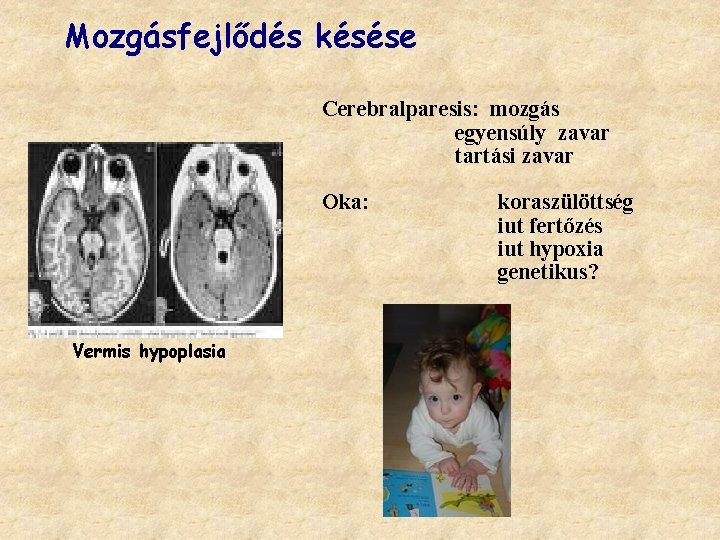 Mozgásfejlődés késése Cerebralparesis: mozgás egyensúly zavar tartási zavar Oka: Vermis hypoplasia koraszülöttség iut fertőzés