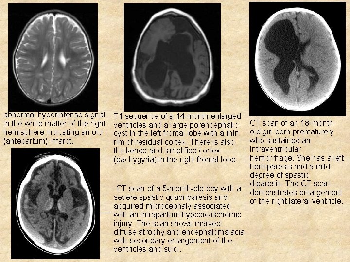abnormal hyperintense signal in the white matter of the right hemisphere indicating an old