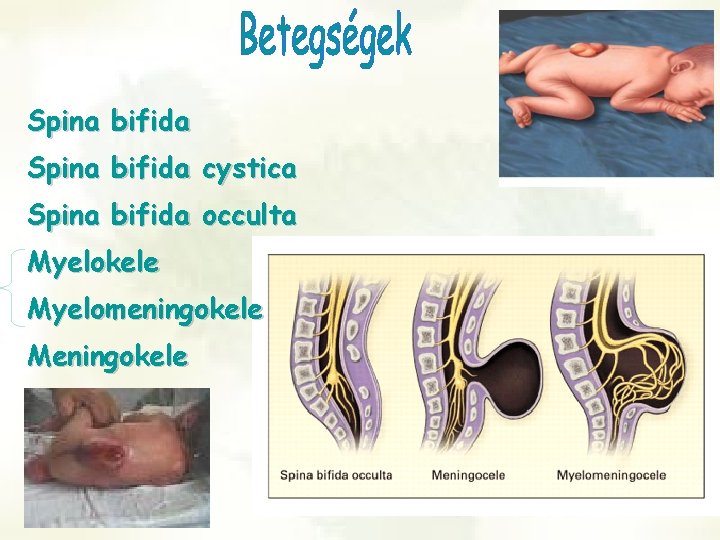 Spina bifida cystica Spina bifida occulta Myelokele Myelomeningokele Meningokele 