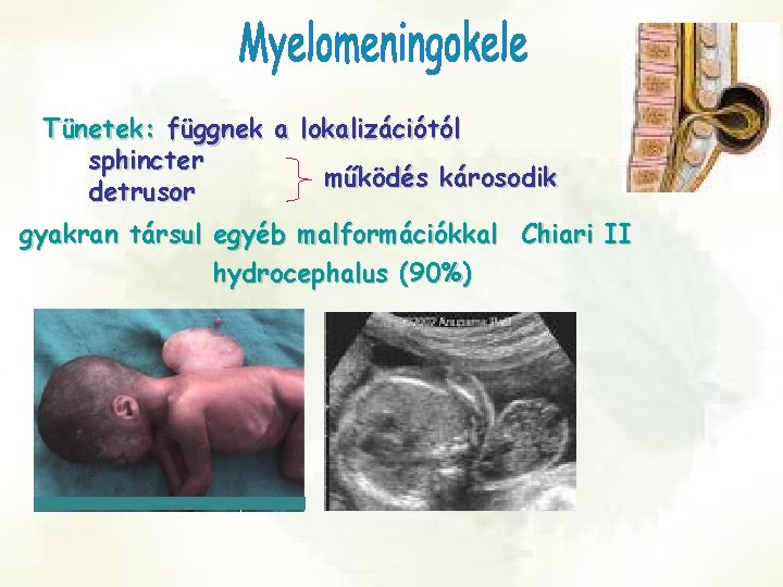Tünetek: függnek a lokalizációtól sphincter működés károsodik detrusor gyakran társul egyéb malformációkkal Chiari II