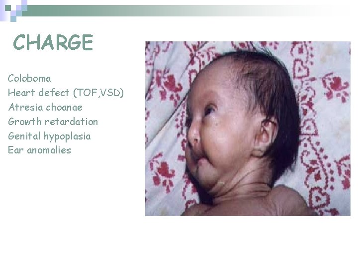 CHARGE Coloboma Heart defect (TOF, VSD) Atresia choanae Growth retardation Genital hypoplasia Ear anomalies