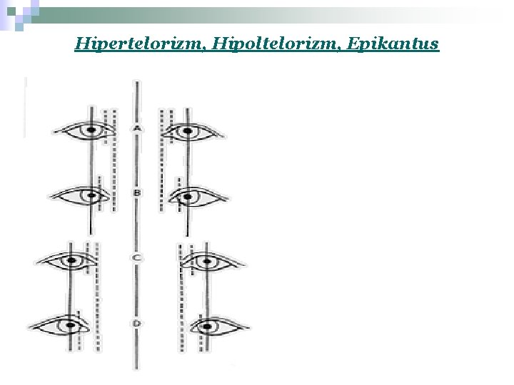 Hipertelorizm, Hipoltelorizm, Epikantus 