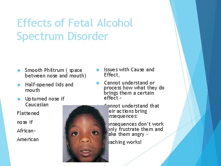 Effects of Fetal Alcohol Spectrum Disorder Smooth Philtrum ( space between nose and mouth)