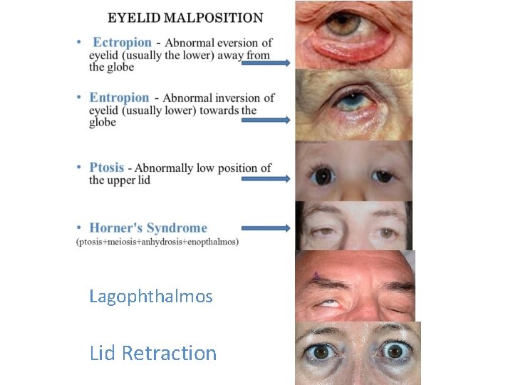 Lagophthalmos Lid Retraction 