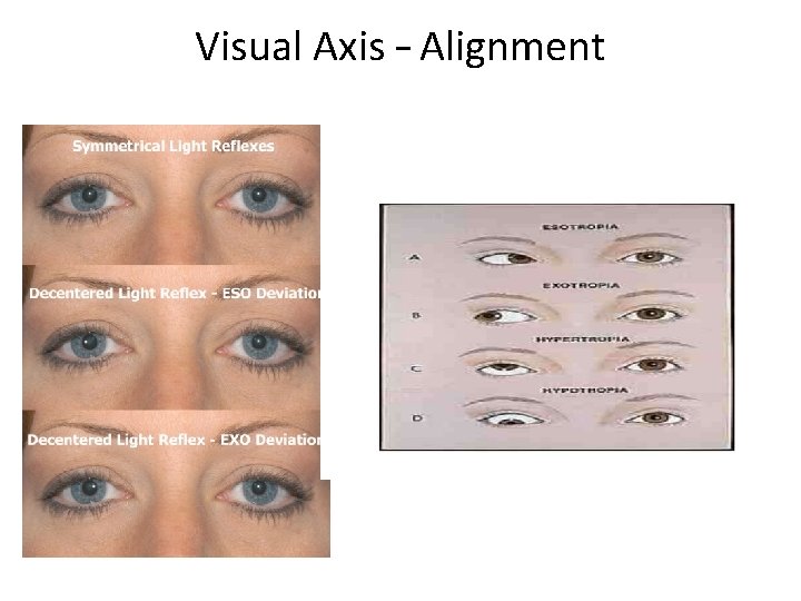 Visual Axis – Alignment 