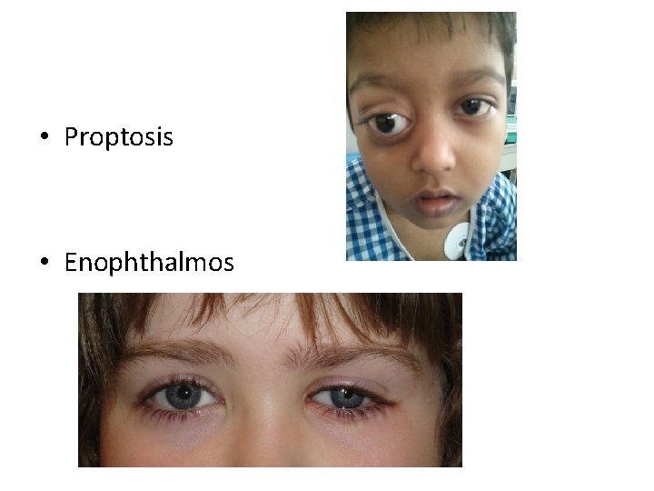  • Proptosis • Enophthalmos 