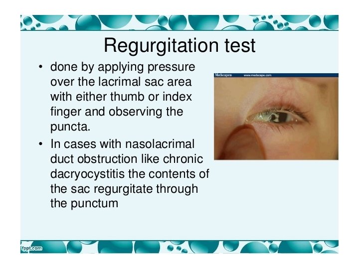  • Regurgitation test 