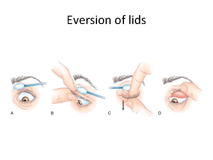 Eversion of lids 