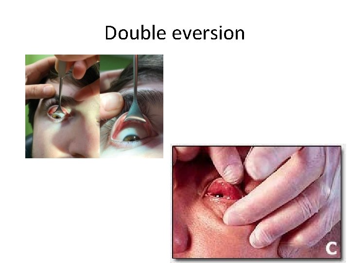 Double eversion 