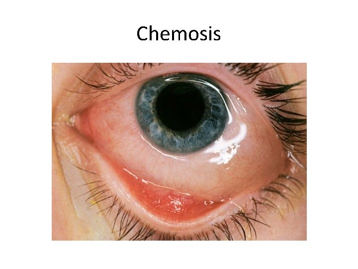 Chemosis 