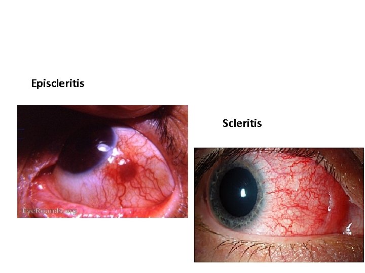 Episcleritis Scleritis 