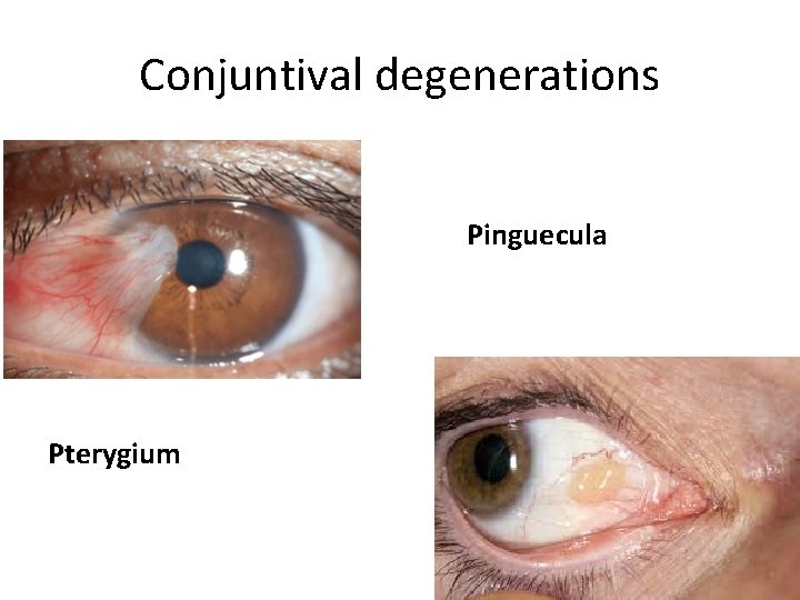 Conjuntival degenerations Pinguecula Pterygium 