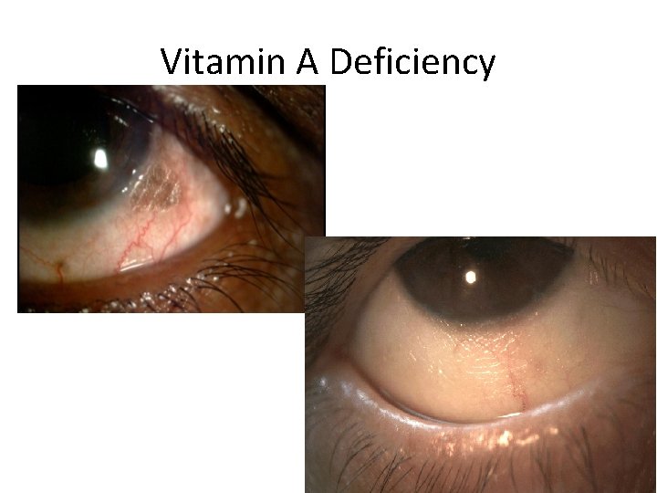 Vitamin A Deficiency 