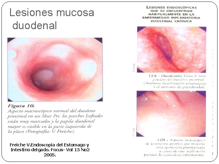 Lesiones mucosa duodenal Freiche V. Endoscopia del Estomago y Intestino delgado. Focus- Vol 15