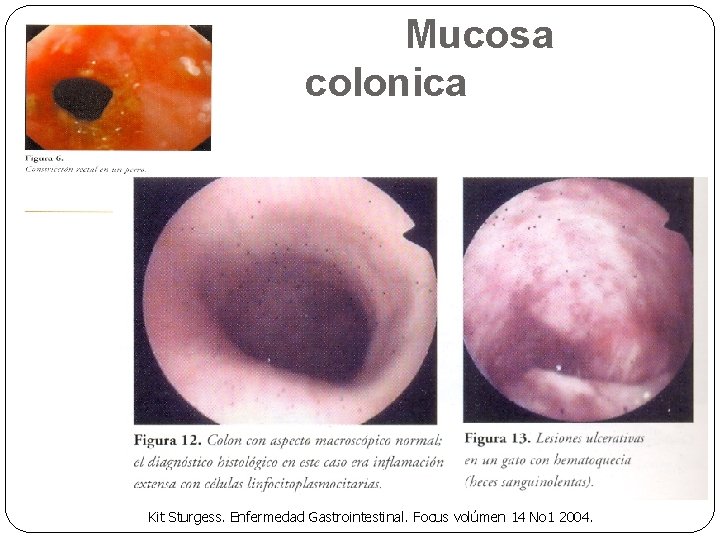 Mucosa colonica Kit Sturgess. Enfermedad Gastrointestinal. Focus volúmen 14 No 1 2004. 