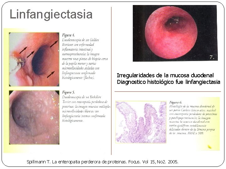 Linfangiectasia Irregularidades de la mucosa duodenal Diagnostico histológico fue linfangiectasia Spillmann T. La enteropatia