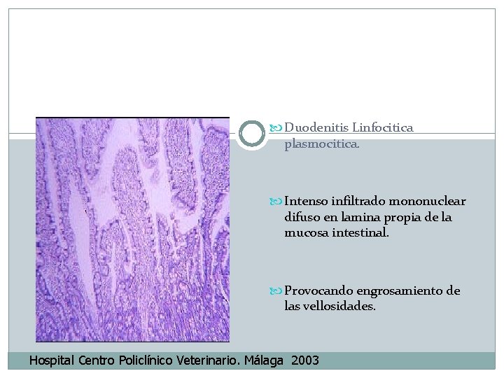  Duodenitis Linfocitica plasmocitica. Intenso infiltrado mononuclear difuso en lamina propia de la mucosa