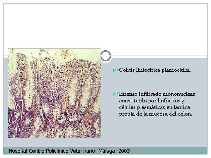  Colitis linfocitica plamocitica. Intenso infiltrado mononuclear constituido por linfocitos y células plasmáticas en