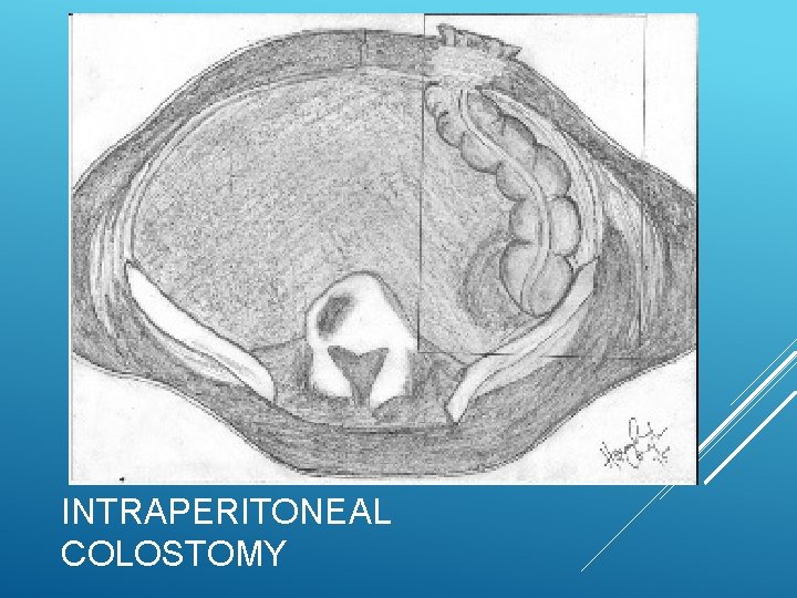 INTRAPERITONEAL COLOSTOMY INTRAPERITONEAL COLOSTOMY