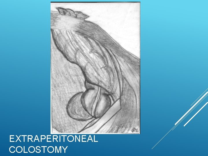 EXTRAPERITONEAL COLOSTOMY EXTRAPERITONEAL COLOSTOMY