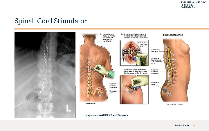 FOR INTERNAL USE ONLY | PRIVATE & CONFIDENTIAL Spinal Cord Stimulator Image sources ADTRR