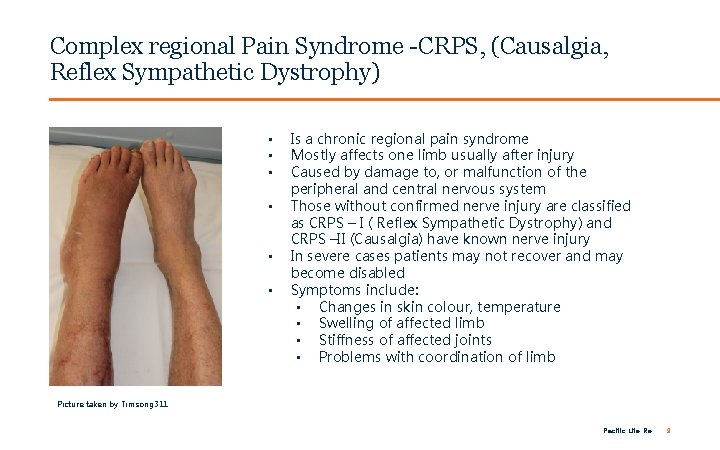 FOR INTERNAL USE ONLY / PRIVATE & CONFIDENTIAL Complex regional Pain Syndrome -CRPS, (Causalgia,