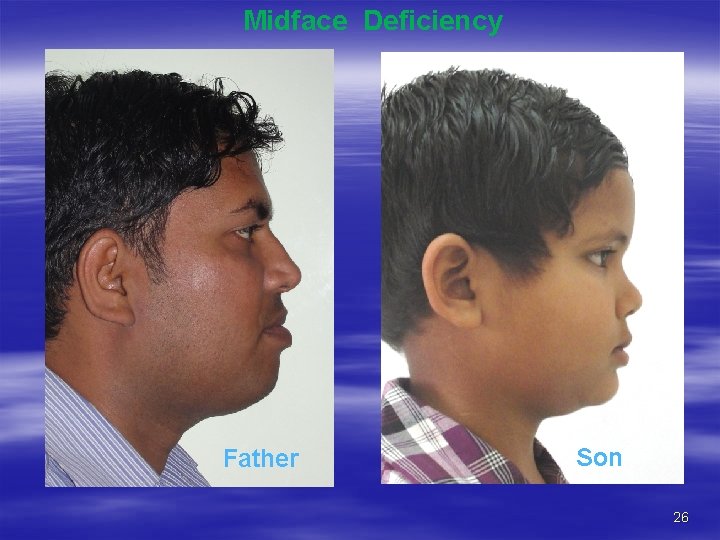 Midface Deficiency Father Son 26 