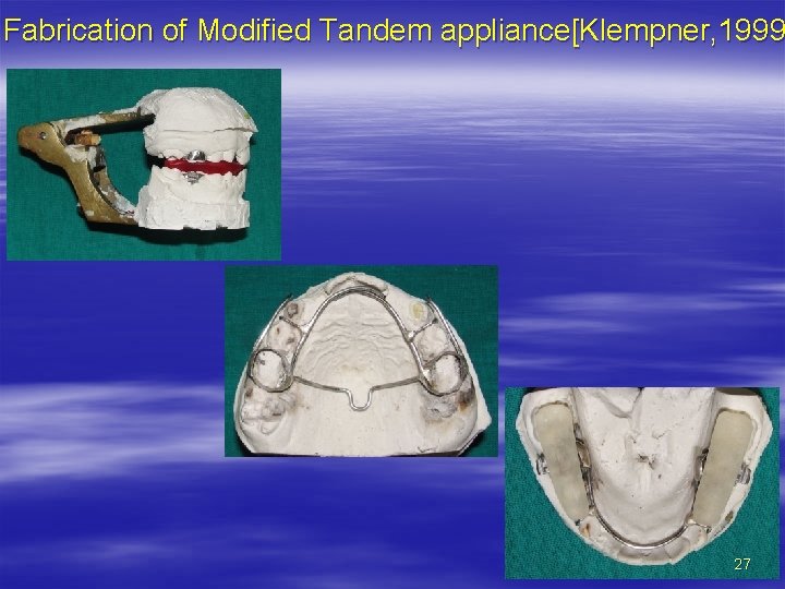 Fabrication of Modified Tandem appliance[Klempner, 1999 27 