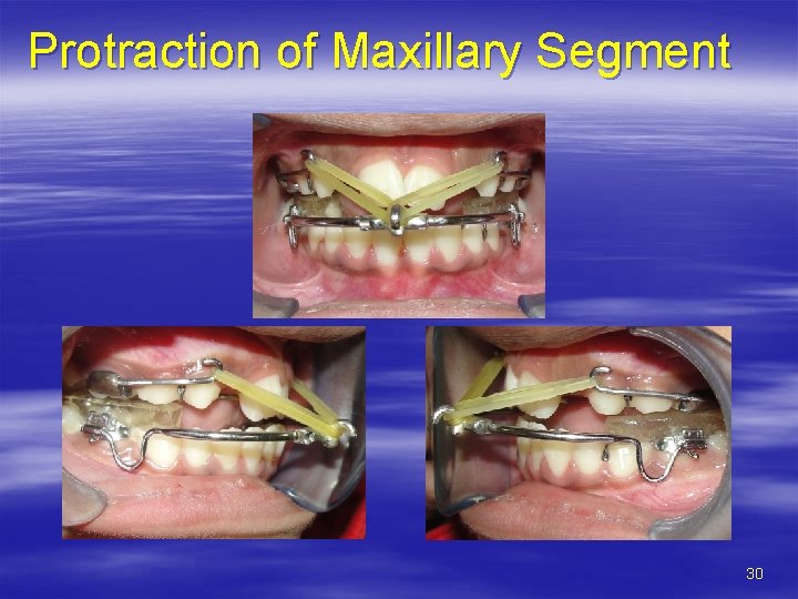 Protraction of Maxillary Segment 30 