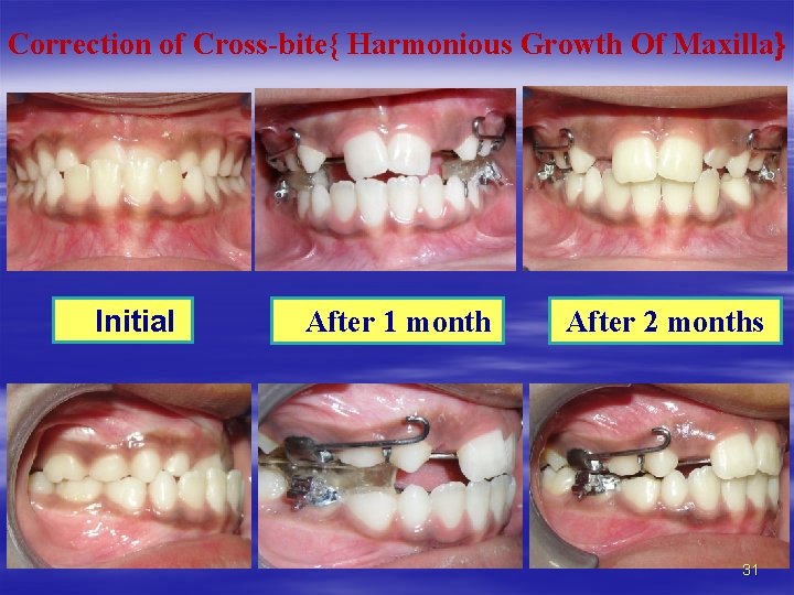 Correction of Cross-bite{ Harmonious Growth Of Maxilla} Initial After 1 month After 2 months