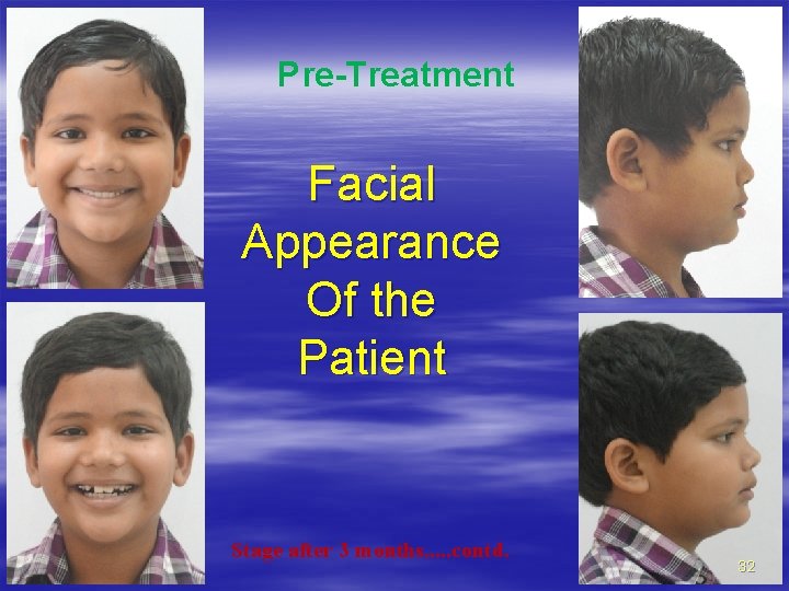 Pre-Treatment Facial Appearance Of the Patient Stage after 3 months. . . contd. 32