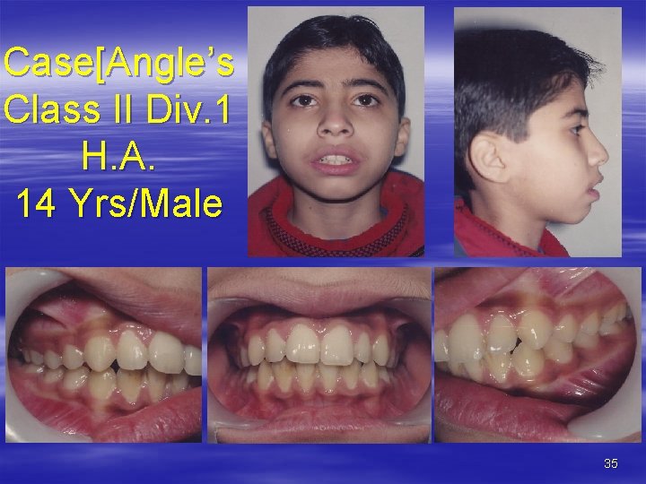 Case[Angle’s Class II Div. 1 H. A. 14 Yrs/Male 35 