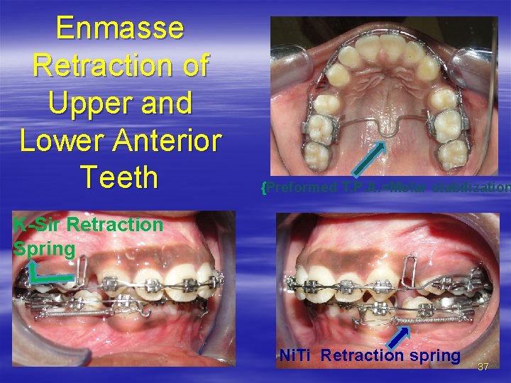 Enmasse Retraction of Upper and Lower Anterior Teeth {Preformed T. P. A. =Molar stabilization