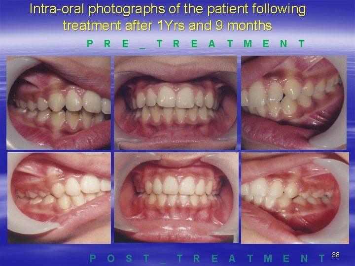 Intra-oral photographs of the patient following treatment after 1 Yrs and 9 months P